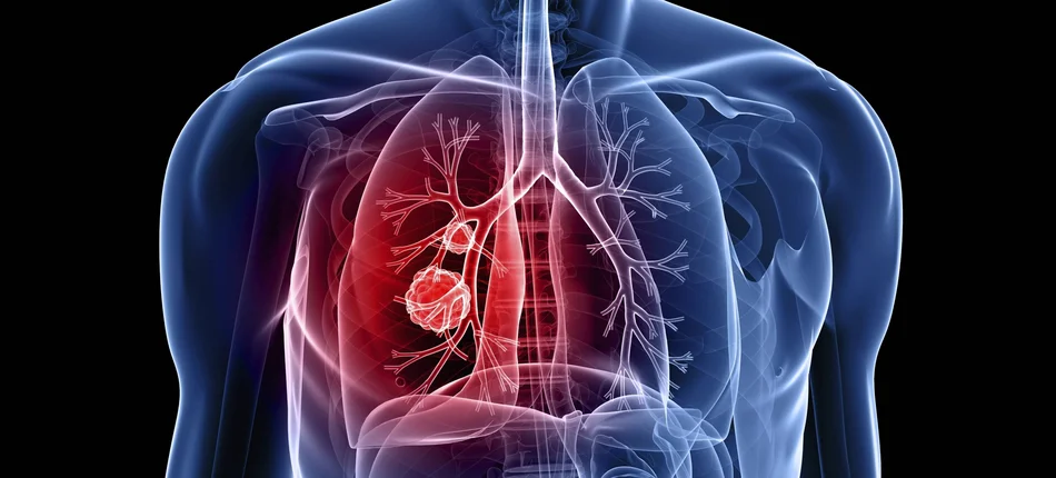 Rząd ignoruje pacjentów z rakiem płuca? - Obrazek nagłówka