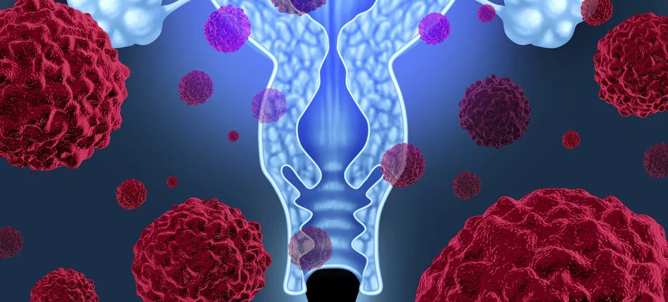 Zapalenia jelit zwiększają zagrożenie rakiem szyjki macicy - Obrazek nagłówka