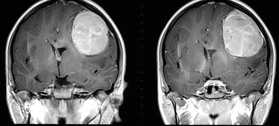 Postęp w terapii groźnego glejaka mózgu - Obrazek nagłówka