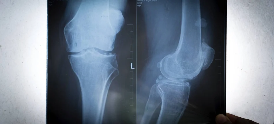 Osteoporoza - choroba cywilizacyjna - Obrazek nagłówka