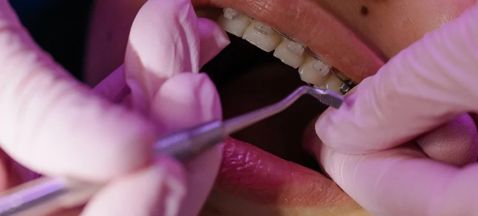 Ortodoncja to nie tylko proste zęby. Sprawdź, w jakich przypadkach może ci pomóc - Obrazek nagłówka