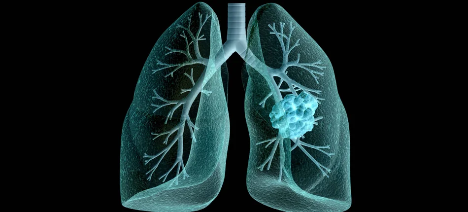 Postęp w terapii niedrobnokomórkowego raka płuca - Obrazek nagłówka