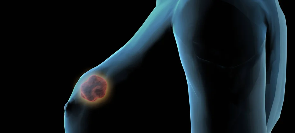 Jest obwieszczenie MZ w sprawie zaleceń diagnostyki i leczenia raka piersi - Obrazek nagłówka