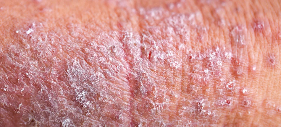Choroby skóry pochłaniają 723 mln funtów rocznie - Obrazek nagłówka