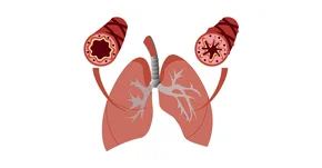 Biologiczna szansa dla osób z ciężką astmą