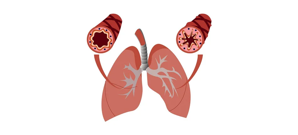 Biologiczna szansa dla osób z ciężką astmą - Obrazek nagłówka