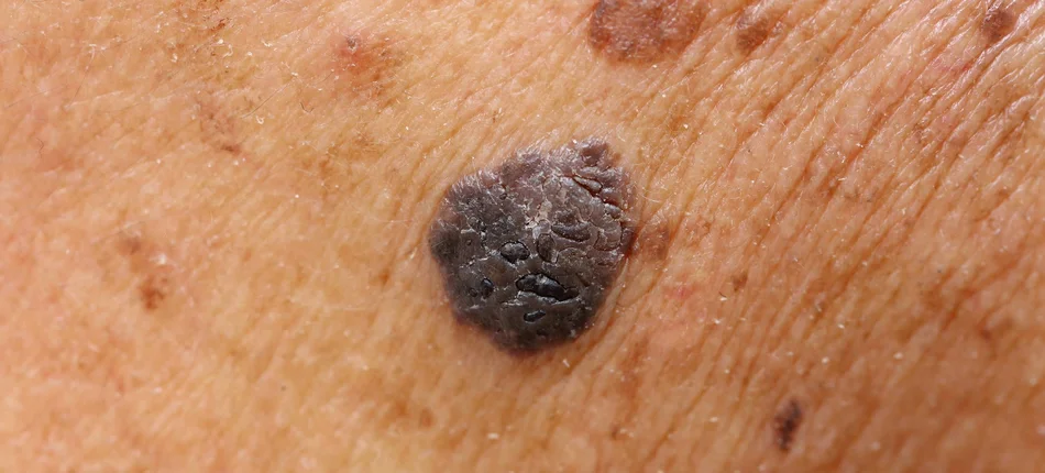 Zaawansowane nowotwory skóry: są terapie, ale brak refundacji - Obrazek nagłówka