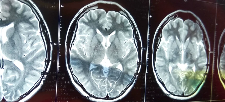 Profilaktyka wtórna udaru mózgu - dabigatran czy aspiryna? - Obrazek nagłówka