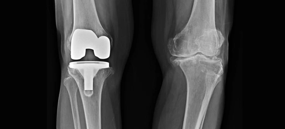 Skąd się bierze niezadowolenie po wszczepieniu endoprotezy stawu kolanowego? - Obrazek nagłówka