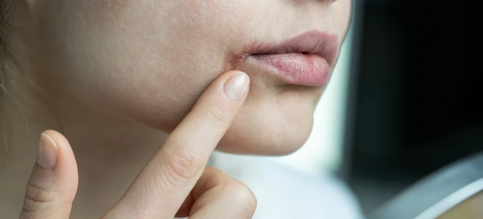 Mouth sores: who gets them  and how to treat them? - Header image