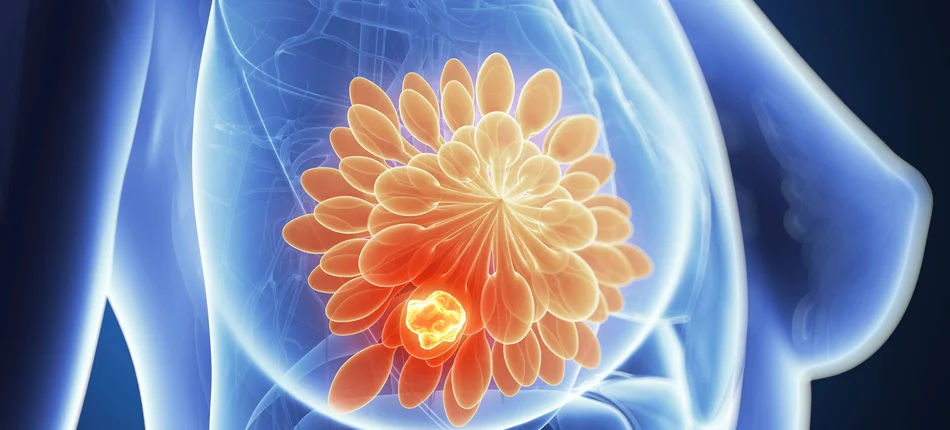 Nowy sposób na ocenę ryzyka przerzutów raka piersi - Obrazek nagłówka