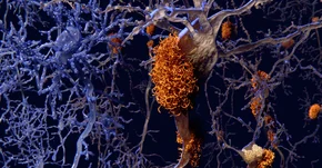 Zbliża się prawdziwy przełom w leczeniu choroby Alzheimera