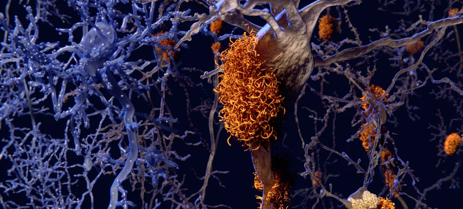 Zbliża się prawdziwy przełom w leczeniu choroby Alzheimera - Obrazek nagłówka