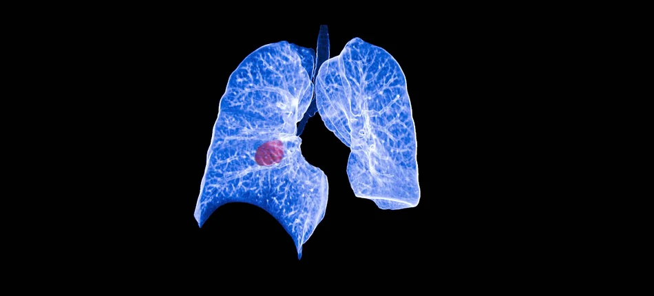 Nowa opcja terapeutyczna dla osób z niedrobnokomórkowym rakiem płuca  - Obrazek nagłówka