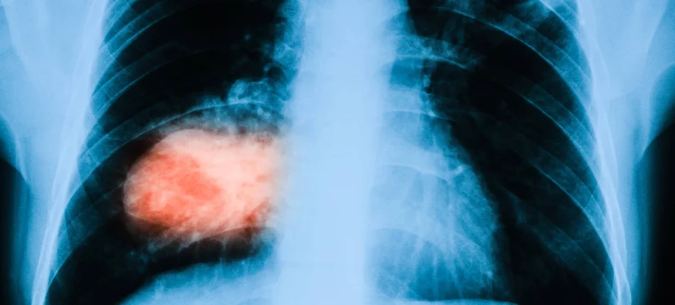 Immunoterapia sprawdza się w terapii raka płuca - Obrazek nagłówka