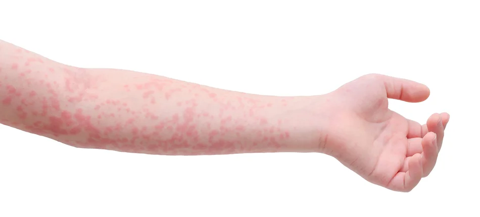 Tydzień alergii z krajowym konsultantem. Część II - objawy i leczenie - Obrazek nagłówka