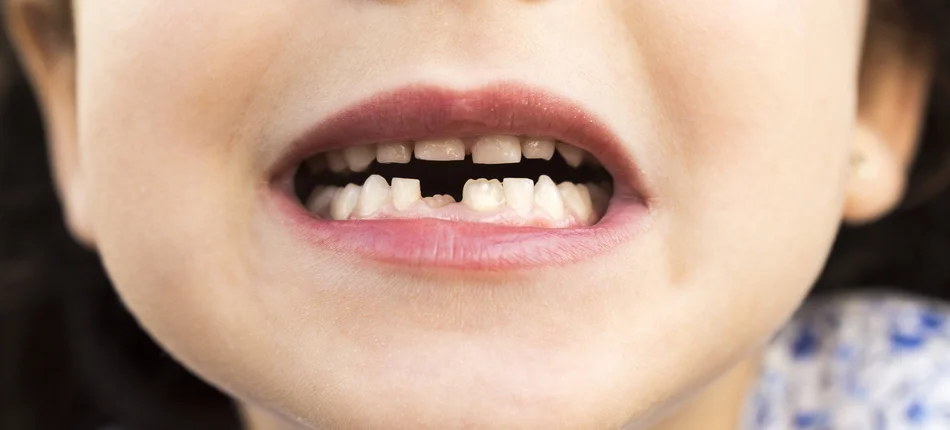 Czy doksycyklina rzeczywiście przebarwia dzieciom zęby? - Obrazek nagłówka