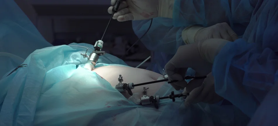 Unique laparoscopic bariatric surgery in a liver transplant patient - Header image