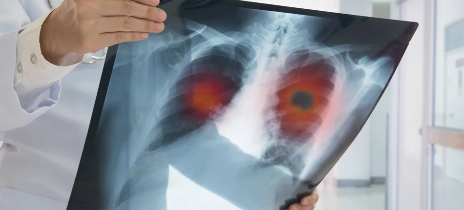 Równi i równiejsi pacjenci z rakiem płuca - Obrazek nagłówka