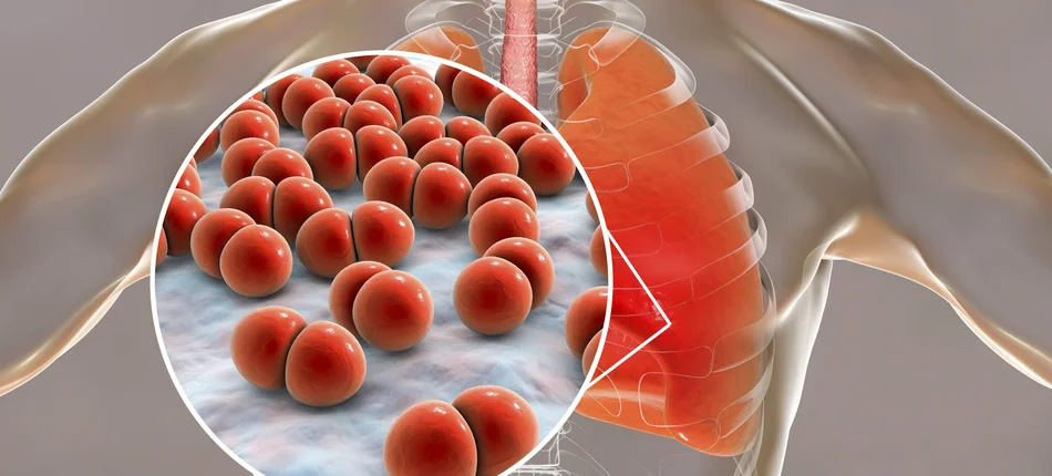 NICE szykuje nowe wytyczne antybiotykoterapii w zapaleniach płuc - Obrazek nagłówka