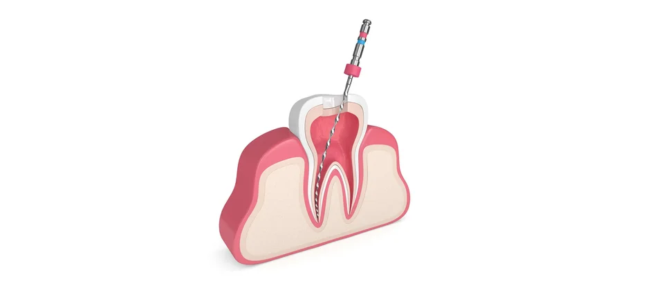 Czy leczenie kanałowe zębów jest szkodliwe? - Obrazek nagłówka