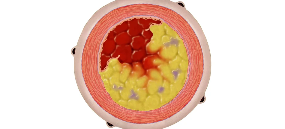 Nowy lek obniżający stężenie cholesterolu - Obrazek nagłówka