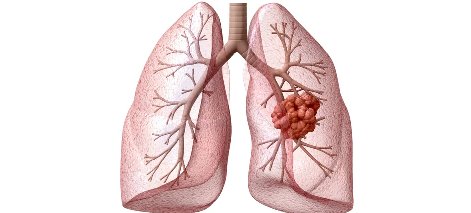 Wciąż bez strategii w leczeniu raka płuca - Obrazek nagłówka