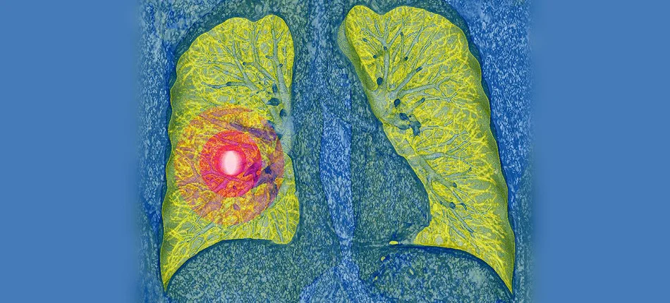 Postęp w terapii raka płuca - Obrazek nagłówka