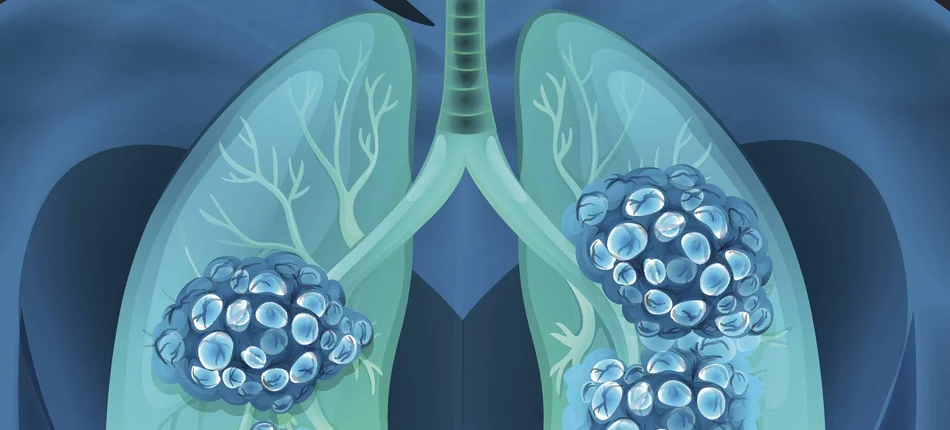 Nowa personalizowana terapia dla chorych na raka płuca - Obrazek nagłówka