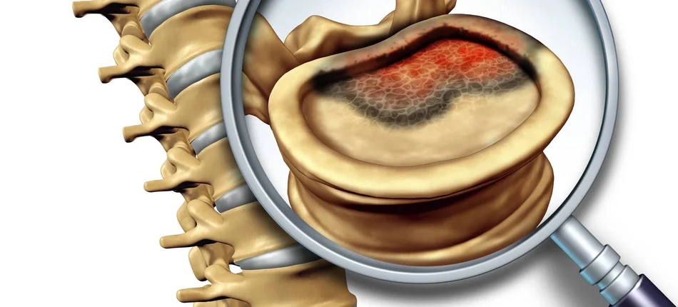 Termoablacja ultradźwiękowa – sposób na bolesne przerzuty do kości - Obrazek nagłówka