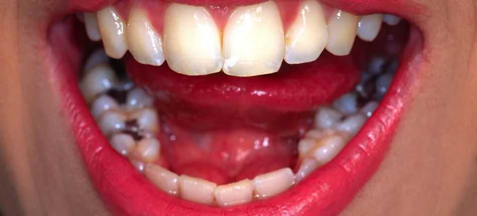Rtęć ma stopniowo znikać z gabinetów stomatologicznych - Obrazek nagłówka
