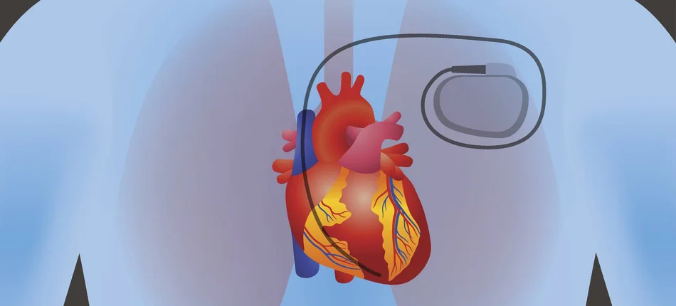  Rozruszniki serca mogą być podatne na atak hakerów - Obrazek nagłówka