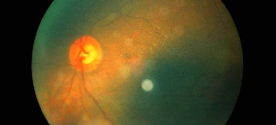 Szansa na przełom w zapobieganiu retinopatii cukrzycowej - Obrazek nagłówka