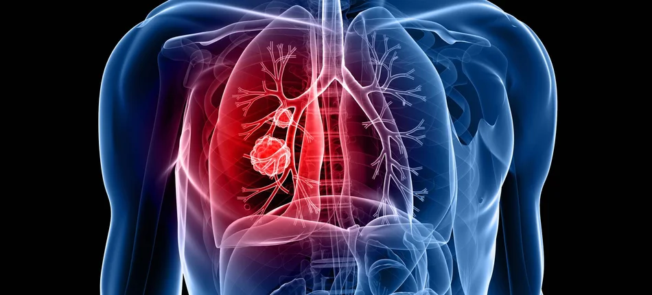 Rak płuca: immunoterapia zamiast chemioterapii już w pierwszym rzucie leczenia - Obrazek nagłówka