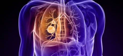 Spotkanie dla pacjentów chorujących na raka płuc - Obrazek nagłówka