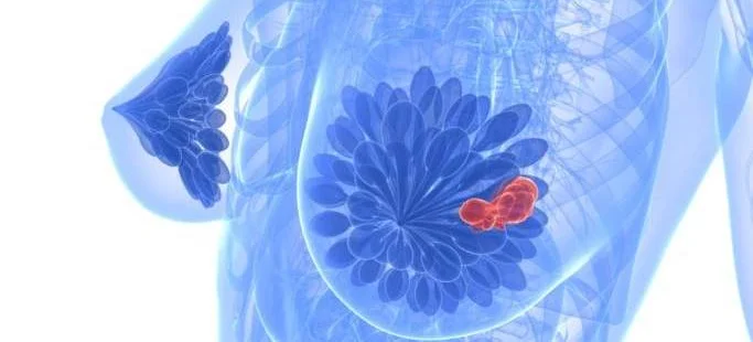 Nowe szanse dla kobiet z wczesnym rakiem piersi o podwyższonym ryzyku nawrotu - Obrazek nagłówka