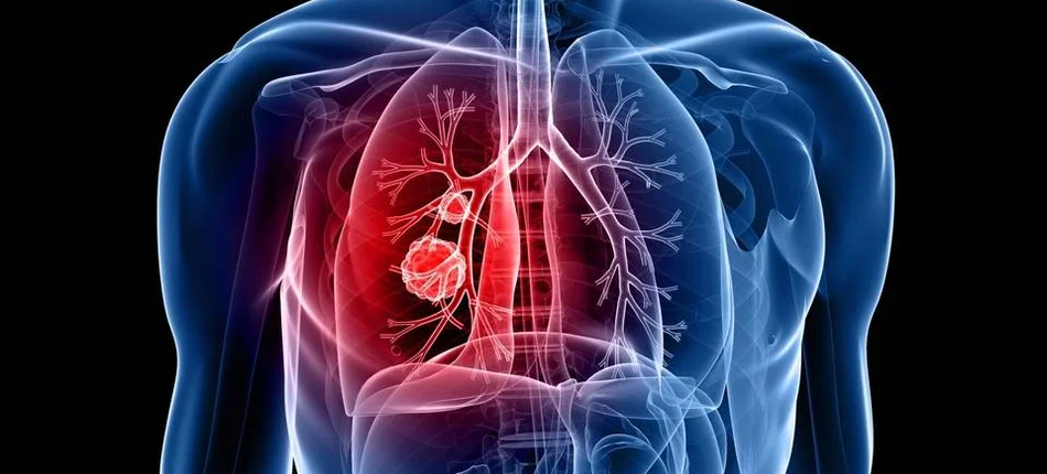 Drobnokomórkowy rak płuca: ważna jest każda minuta - Obrazek nagłówka