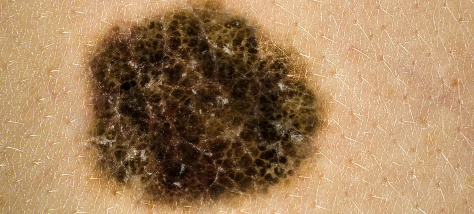 Nowe możliwości leczenia dla chorych na zaawansowanego czerniaka skóry - Obrazek nagłówka