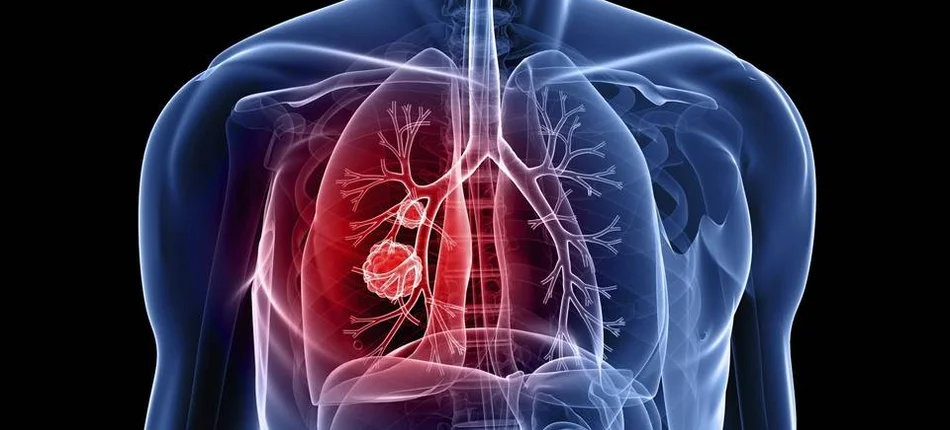Konecki szpital i Świętokrzyskie Centrum Onkologii będą wspólnie walczyć z rakiem płuc - Obrazek nagłówka