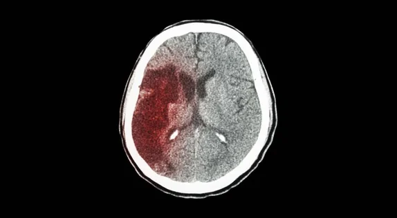 Dostęp do rehabilitacji neurologicznej jest niewystarczający. To kluczowe dla pacjentów po udarze