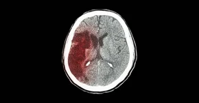 Jak leczyć udary mózgu?