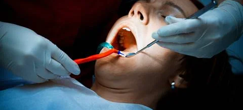 Leczenie zębów zmniejsza ryzyko choroby niedokrwiennej serca - Obrazek nagłówka