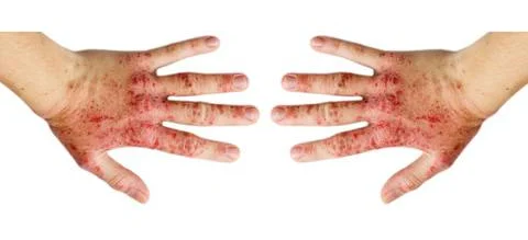 Szansa na postęp w leczeniu atopowego zapalenia skóry - Obrazek nagłówka