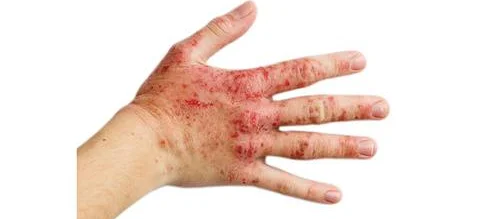 Szansa dla chorych na ciężkie atopowe zapalenie skóry - Obrazek nagłówka