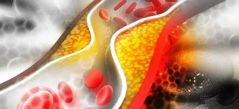 Hipercholesterolemia – mówmy o niej częściej - Obrazek nagłówka