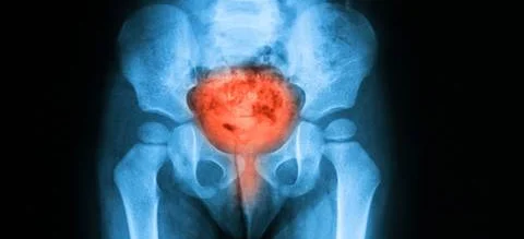 Urolog powinien być koordynatorem opieki nad pacjentem chorym na raka pęcherza moczowego - Obrazek nagłówka