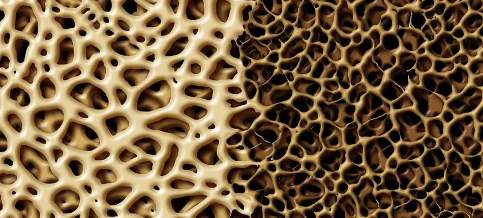 Leczenie osteoporozy to mniejsze ryzyko zgonu nawet po złamaniu - Obrazek nagłówka