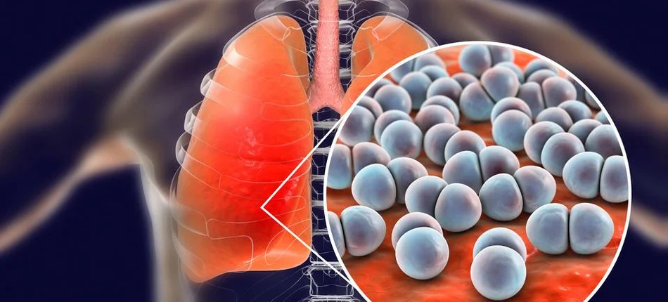 Zapalenie płuc szczególnie groźne w pandemii - Obrazek nagłówka
