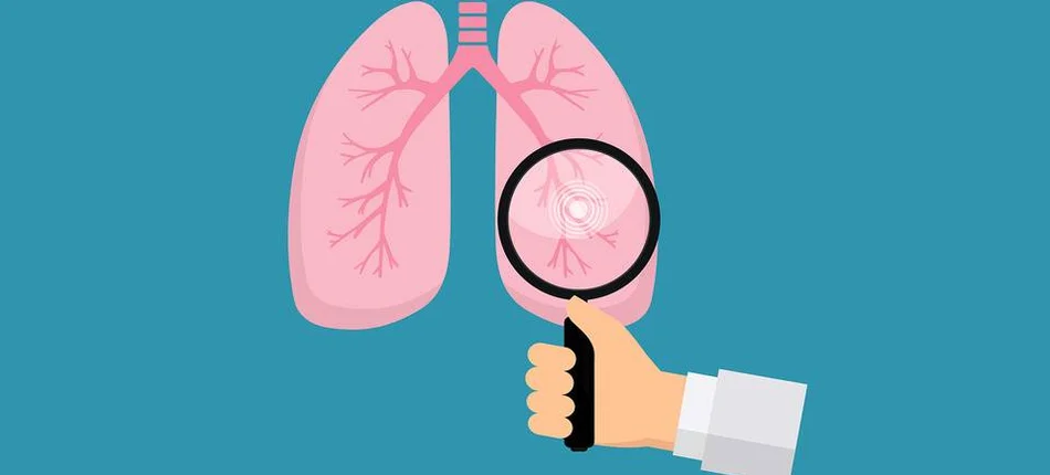 Rak płuca: najważniejszy dzień życia - Obrazek nagłówka