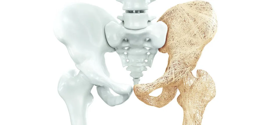 Osteoporoza: kręta ścieżka do diagnozy - Obrazek nagłówka